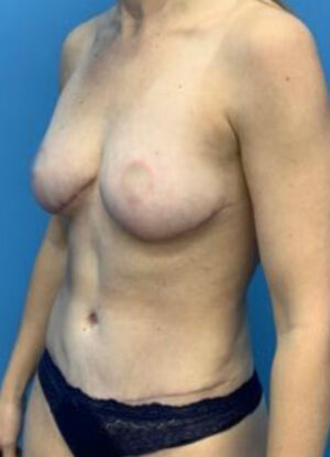 Abdominoplasty