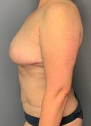Abdominoplasty