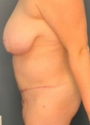 Abdominoplasty