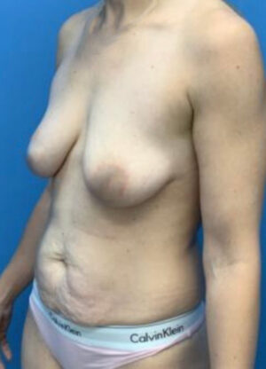 Abdominoplasty