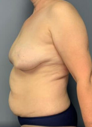 Abdominoplasty