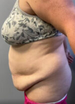 Abdominoplasty
