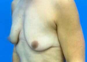 Breast Lift