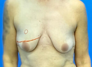 Breast Lift