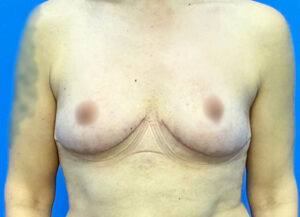 Breast Lift