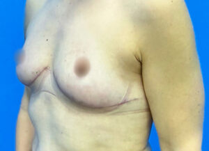 Breast Lift