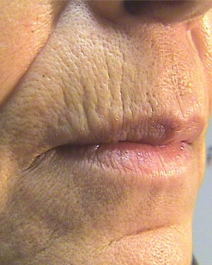 Laser Resurfacing