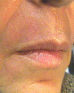 Laser Resurfacing