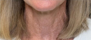 Laser Resurfacing