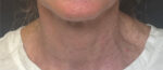 Laser Resurfacing