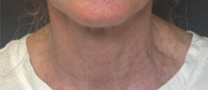 Laser Resurfacing