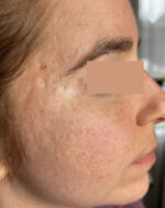Laser Resurfacing