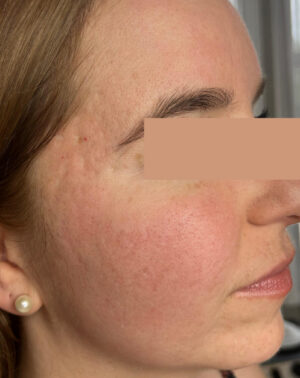 Laser Resurfacing