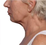 Non-surgical Body Contouring