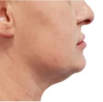 Non-surgical Body Contouring