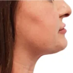 Non-surgical Body Contouring