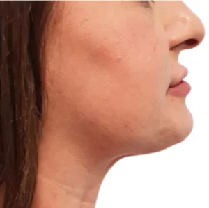 Non-surgical Body Contouring