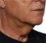 Non-surgical Body Contouring