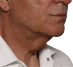 Non-surgical Body Contouring