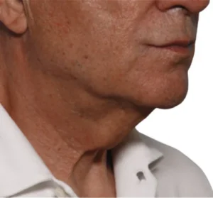 Non-surgical Body Contouring