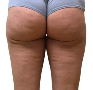 Non-surgical Body Contouring