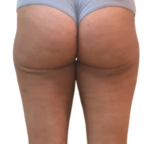 Non-surgical Body Contouring