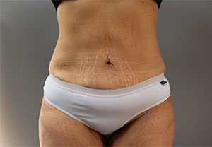 Before Tummy Tuck