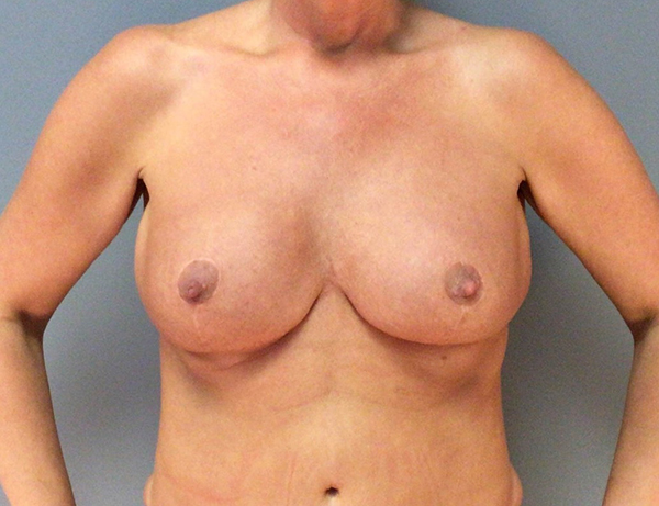 Before Breast Revision