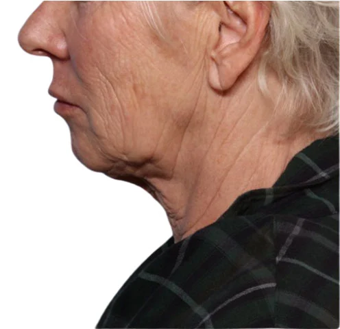 Before Non-surgical Body Contouring