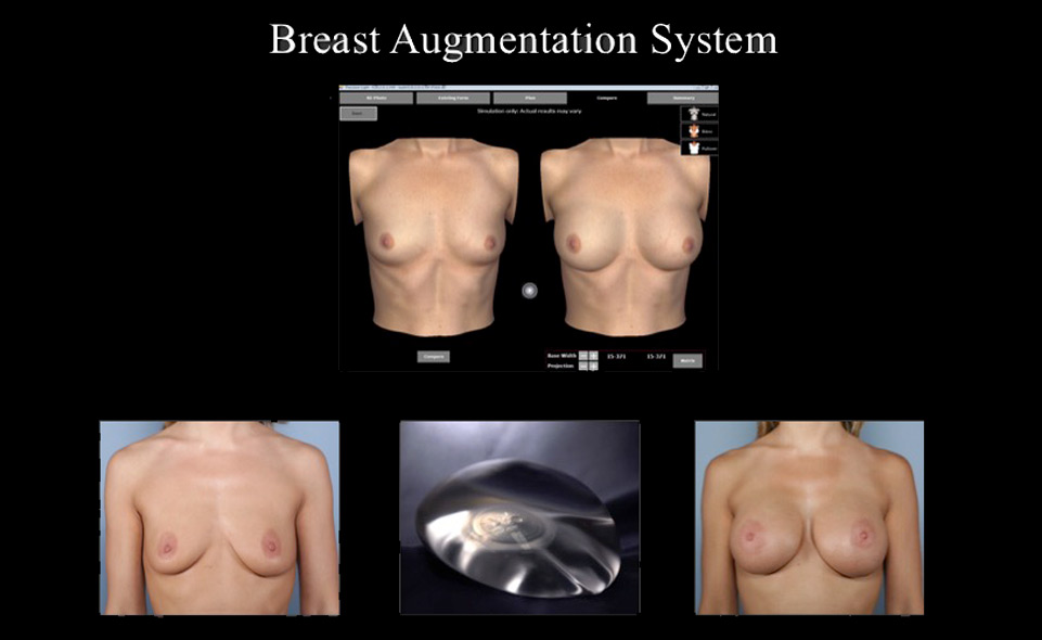 Breast Augmentation System Rochester